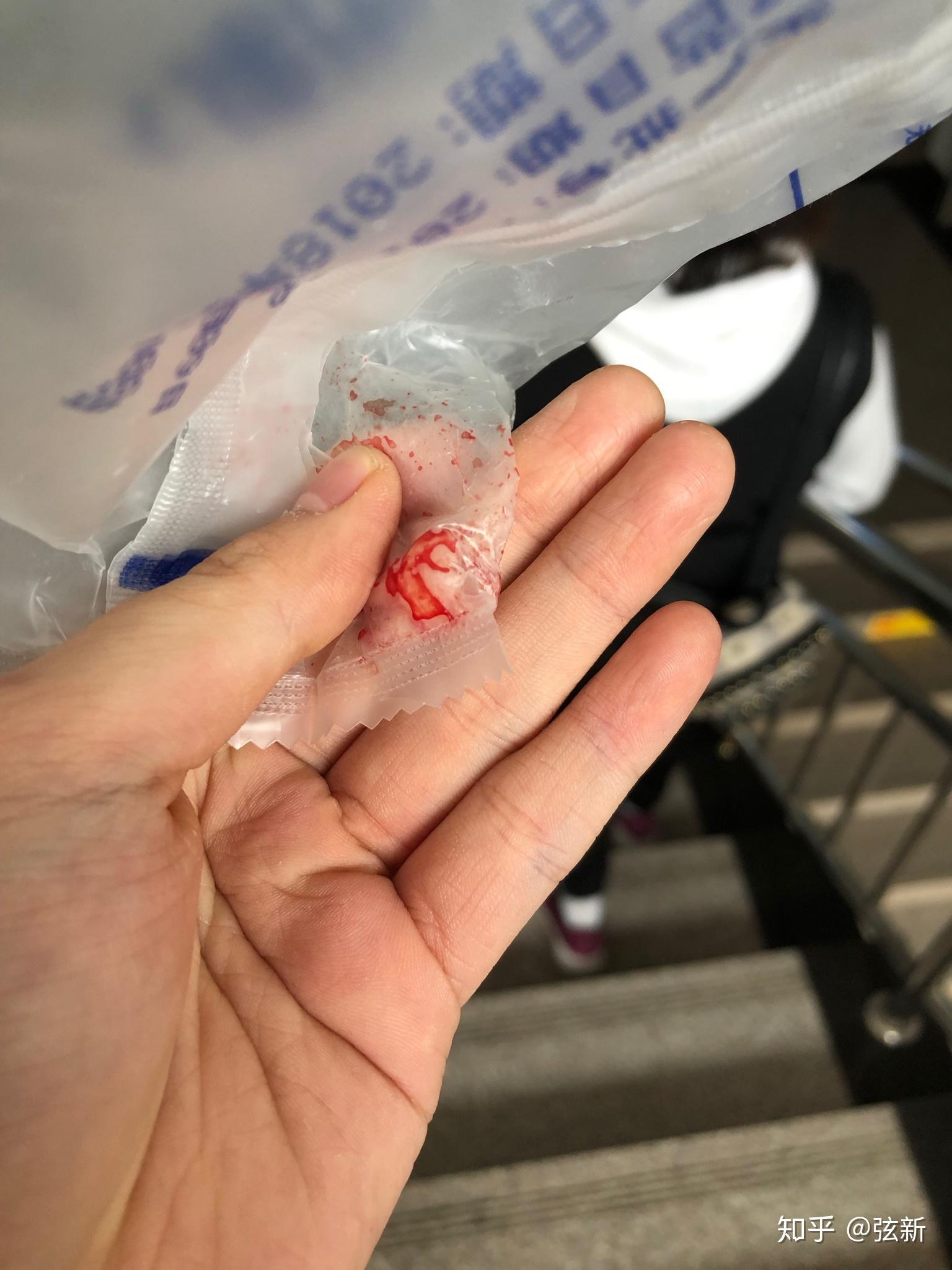拔智齿后坐飞机爆血